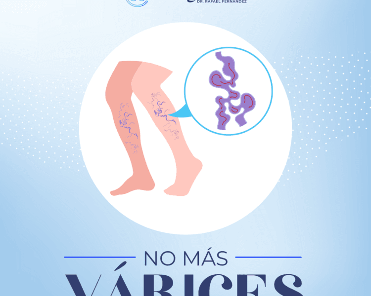 Láser para Várices