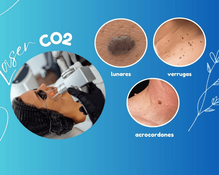 Laser Co2-Lunares ⚫