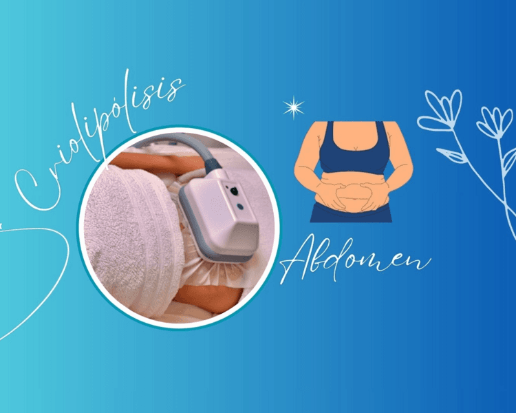 Criolipólisis 1 zona
