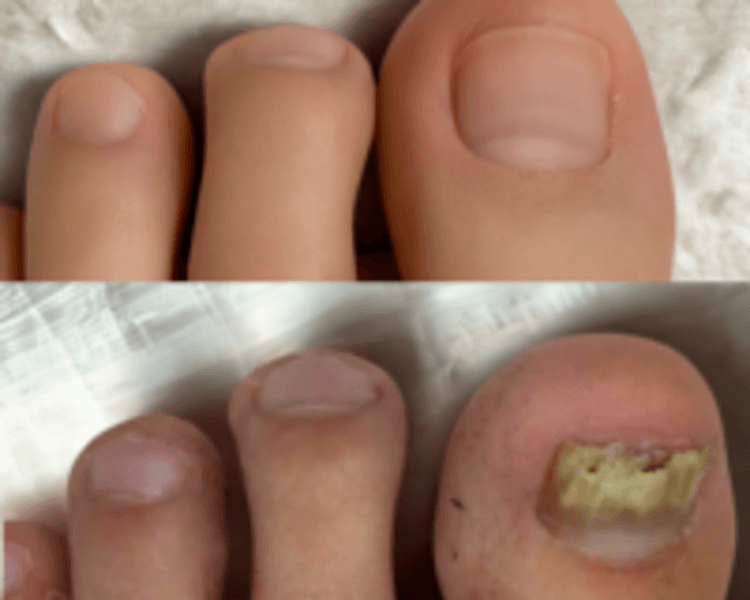 Onicoplastia o Reconstrucción Ungueal