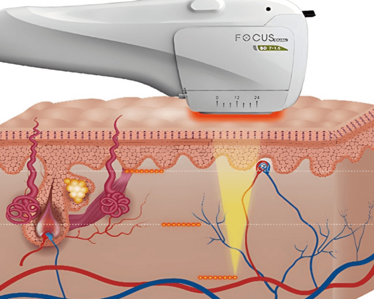 Hifu rollito sostén