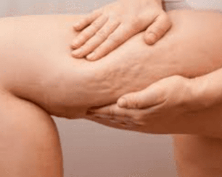 Tratamientos Combinados - Combatir Celulitis