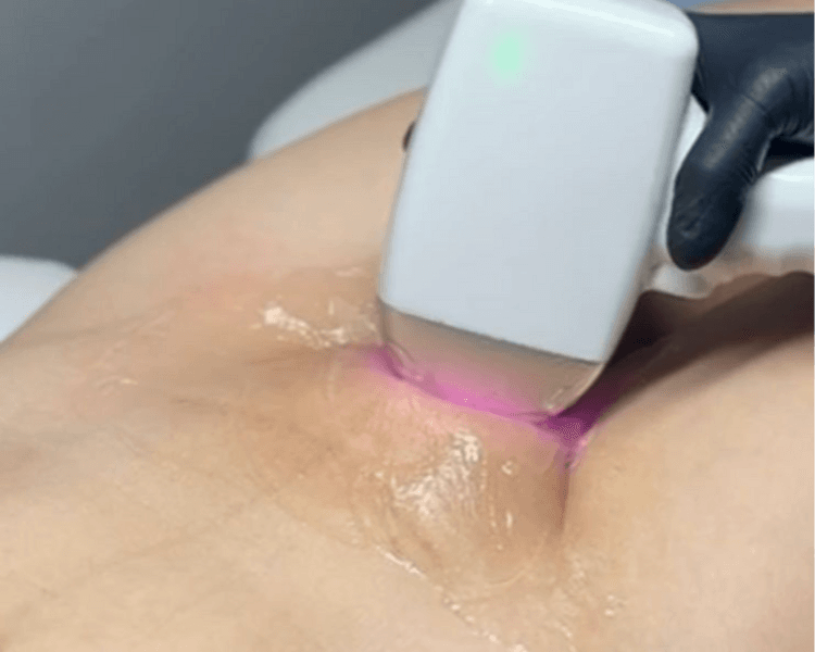 LASER BIKINI COMPLETO