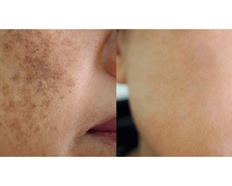 Tratamiento facial despigmentante