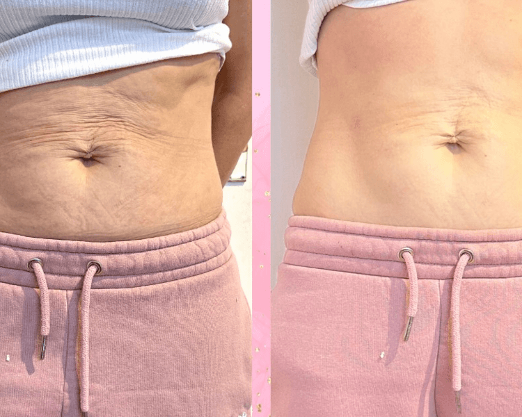 HIFU 25D: Abdomen completo