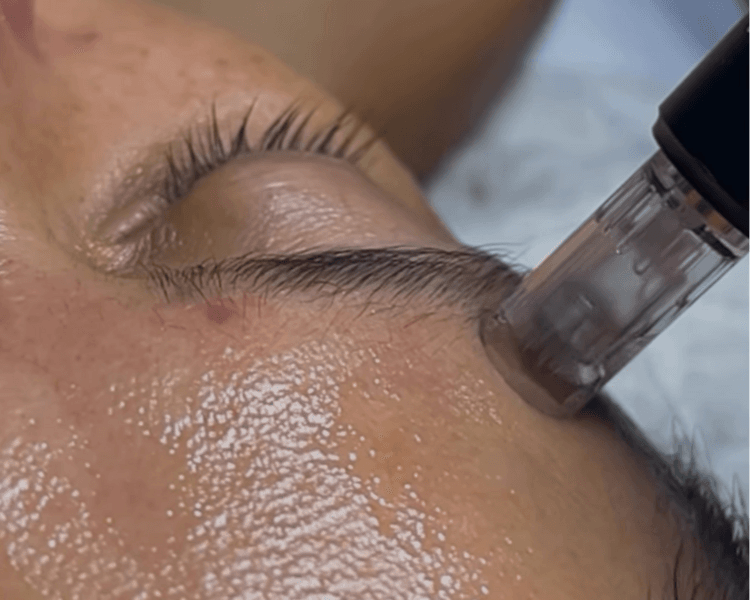 Pack microneedling 3 sesiones