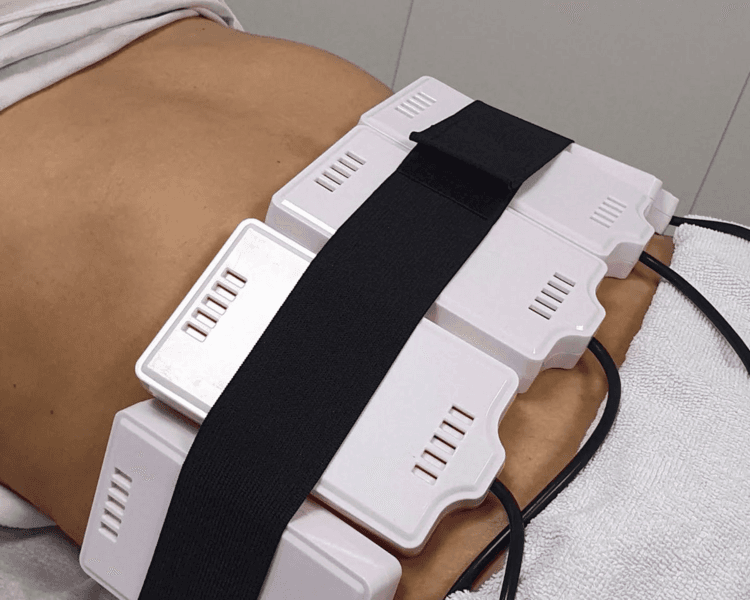 Criolipolisis 2 zonas 1 sesion