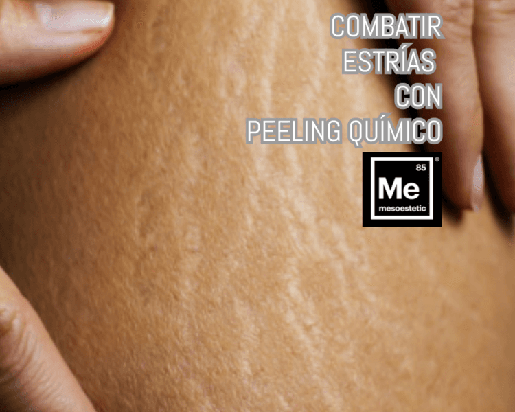 PEELING QUÍMICO ESTRÍAS