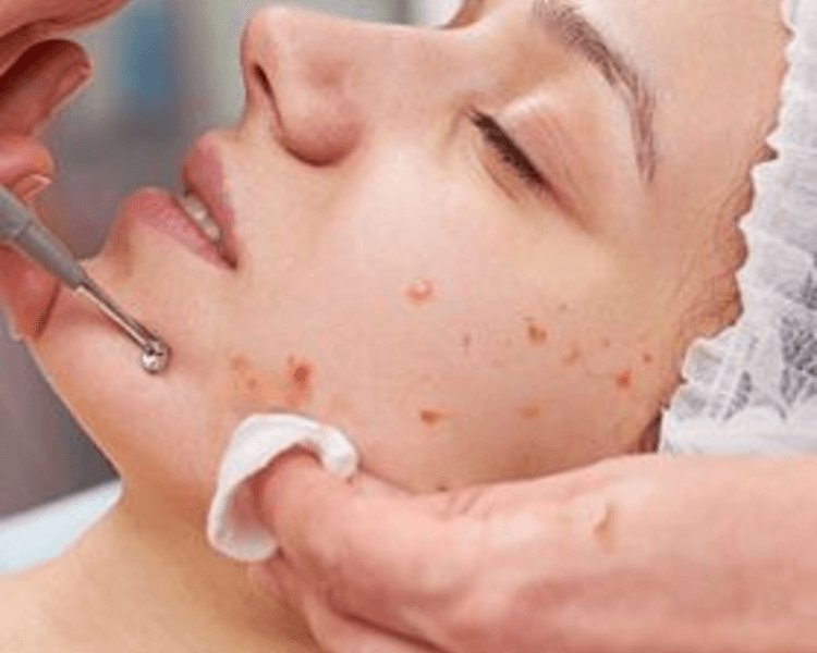 Tratamiento antiacné