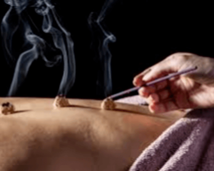 Acupuntura 4 Sesiones