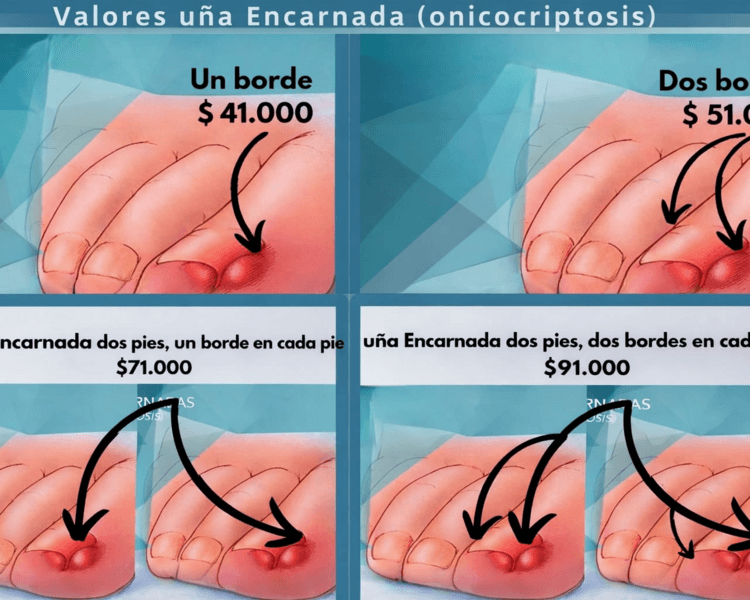 Uña Encarnada Bilateral (ambos bordes)