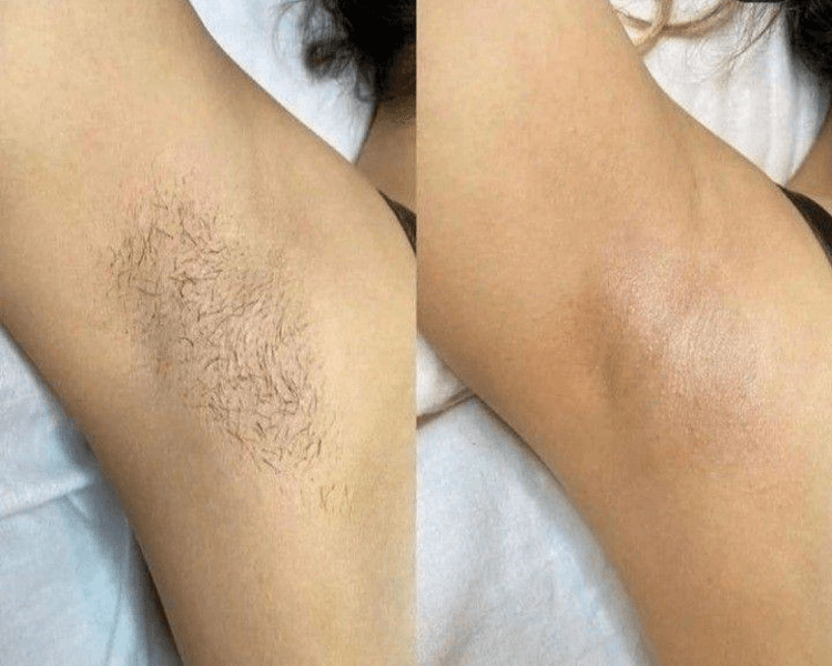 DEPILACION DE AXILAS CON CERA