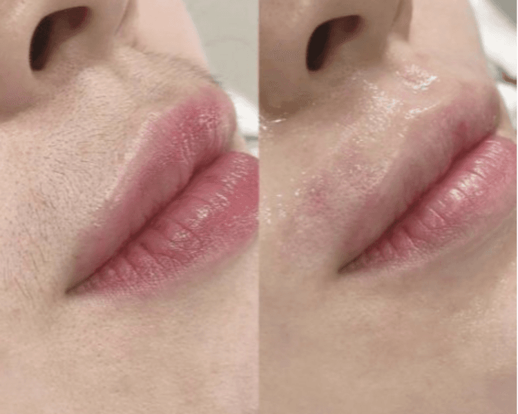 DEPILACIÓN DE BOZO CON CERA