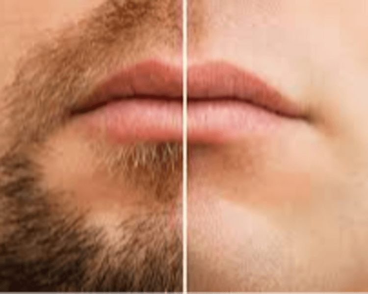 Barba - 6 Sesiones - Depilación Zona M