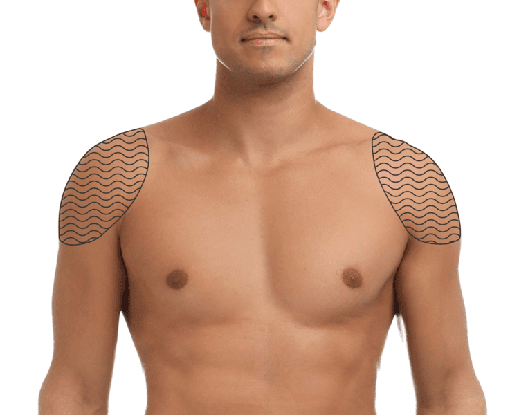 Hombros - 6 Sesiones - Depilación Zona M