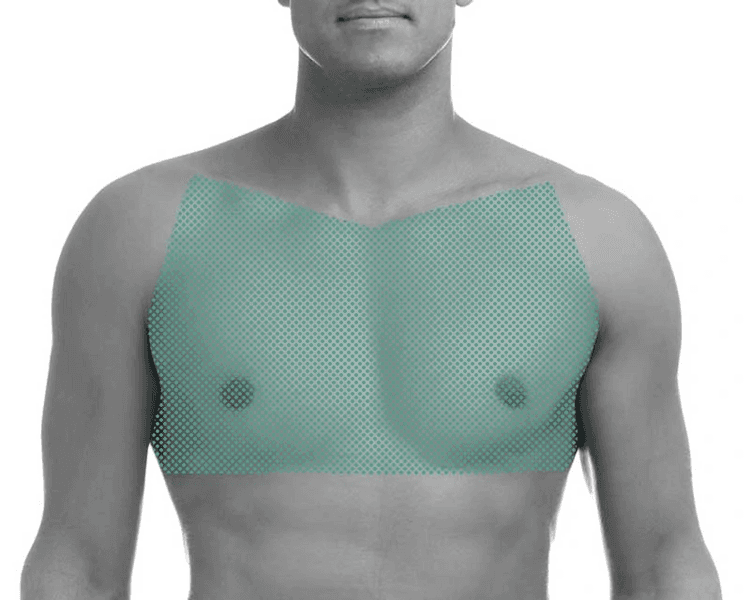 Pecho - 6 Sesiones - Depilación Zona L