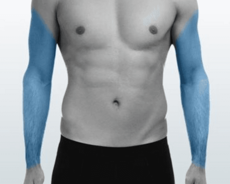 Brazo Completo - 6 Sesiones - Depilación Zona L