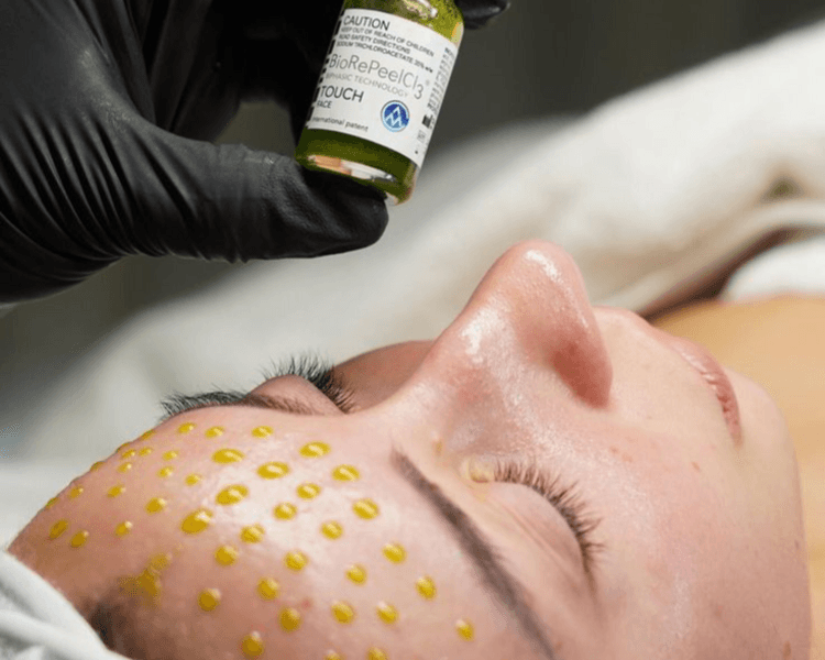 ✨ BIOREPEELCl3® + DERMAPEN