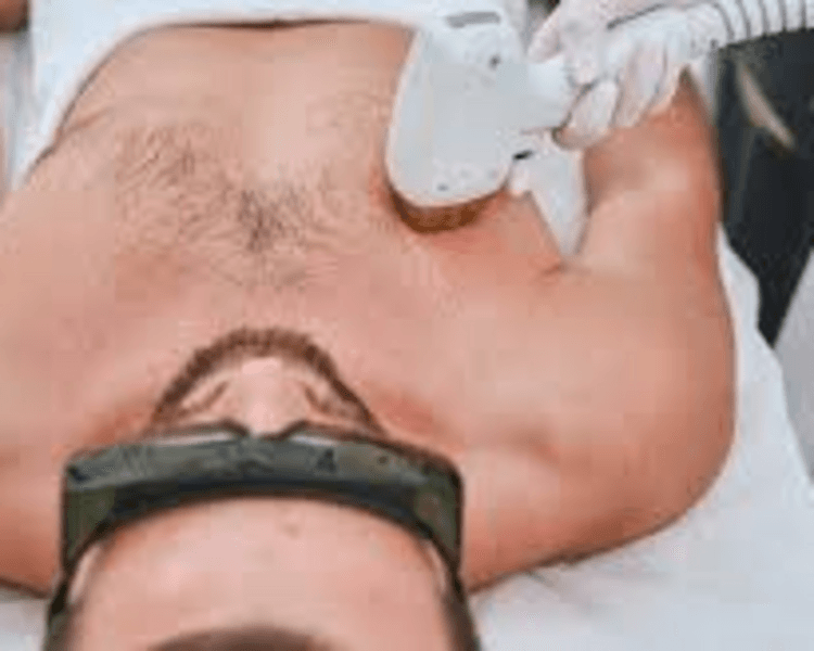 Alpha Smooth (Pecho-Abdomen-Axilas) x 4 sesiones-Precio Unitario $73000