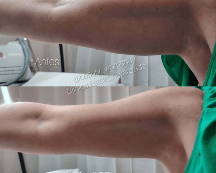 Hifu 25D pro máx cuerpo completo + PASE LIBRE EMSCULPT