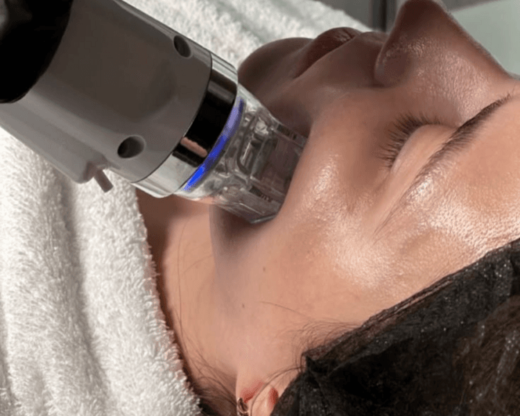 ⚙️ ANTIAGE – RF FRACCIONADA (FRAX FACE)