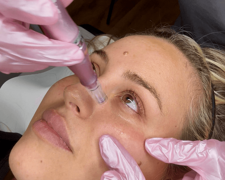 PROTOCOLO DESPIGMENTANTE DE OJERAS