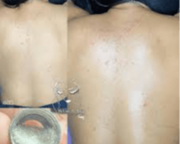 MICRODERMOABRASIÓN DE ESPALDA