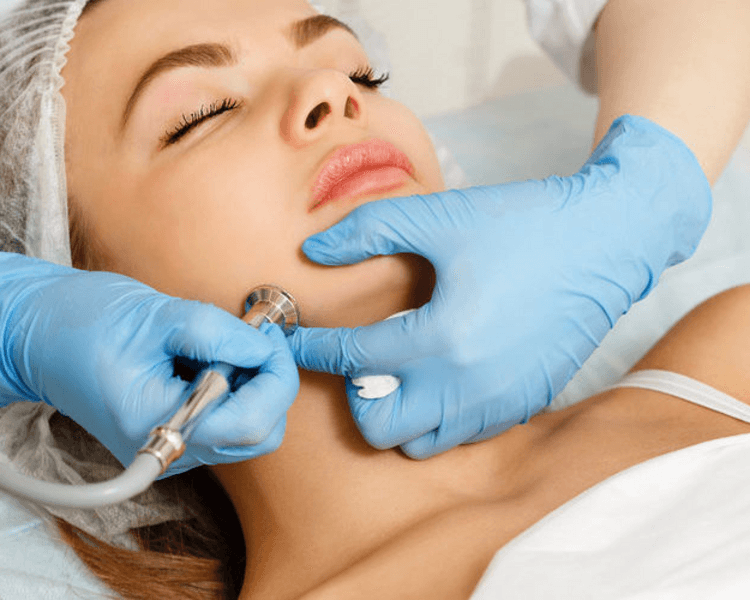 MICRODERMOABRASIÓN FACIAL