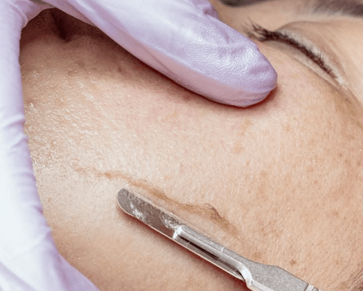 LIMPIEZA DE CUTIS + DERMAPLANING (seña obligatoria de $14.000)