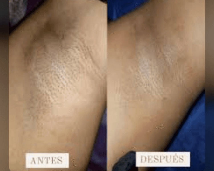 MICRODERMOABRASIÓN FACIAL Y AXILA