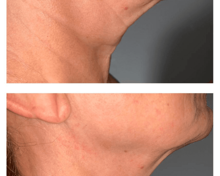 Rostro, cuello y escote