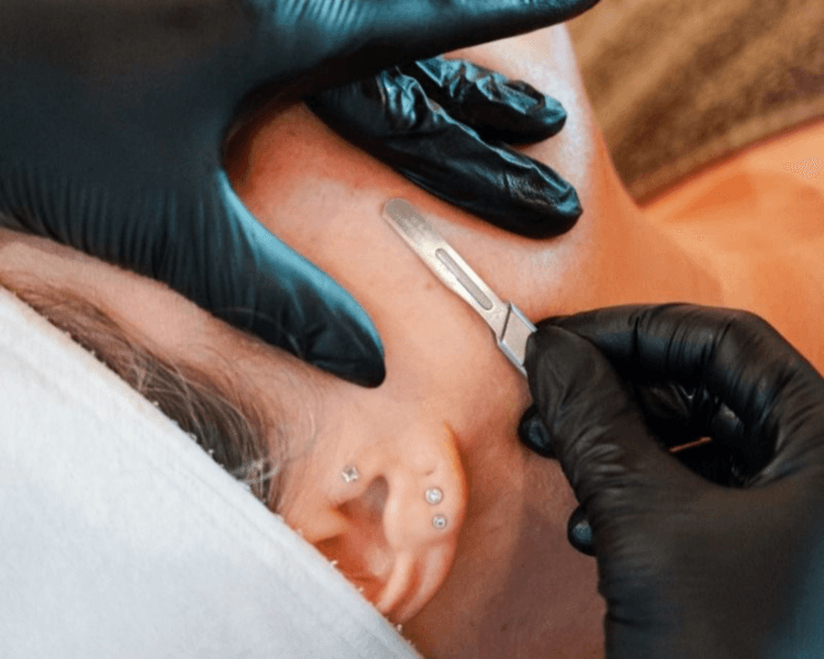 Dermaplaning Clásico