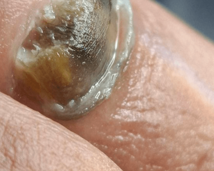 Barrido profundo micosis