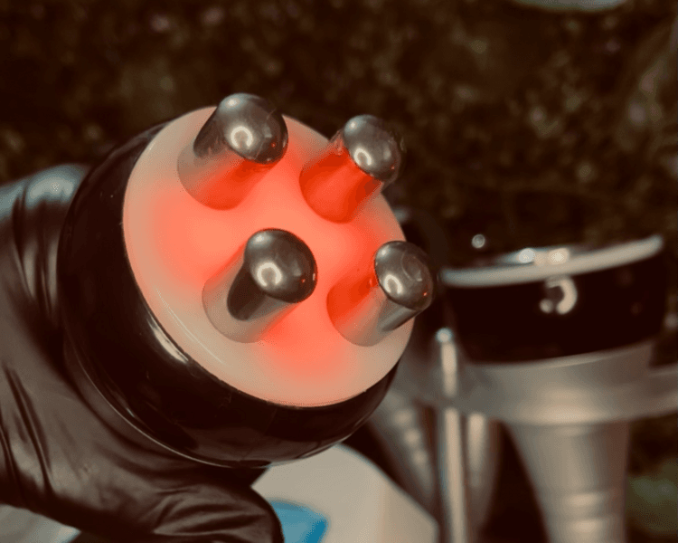 radiofrecuencia facial