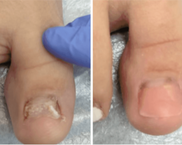 Reconstrucción de uñas