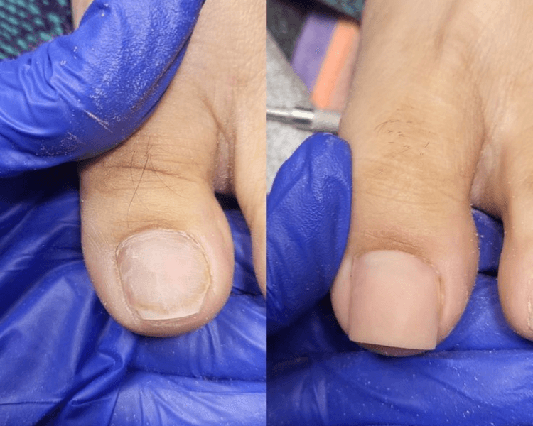 Reconstrucción de uña artificial