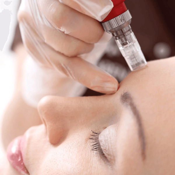 Microneedling 1 sesión / inducción de colágeno