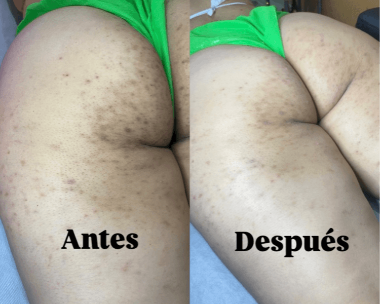 Despigmentación de Glúteos