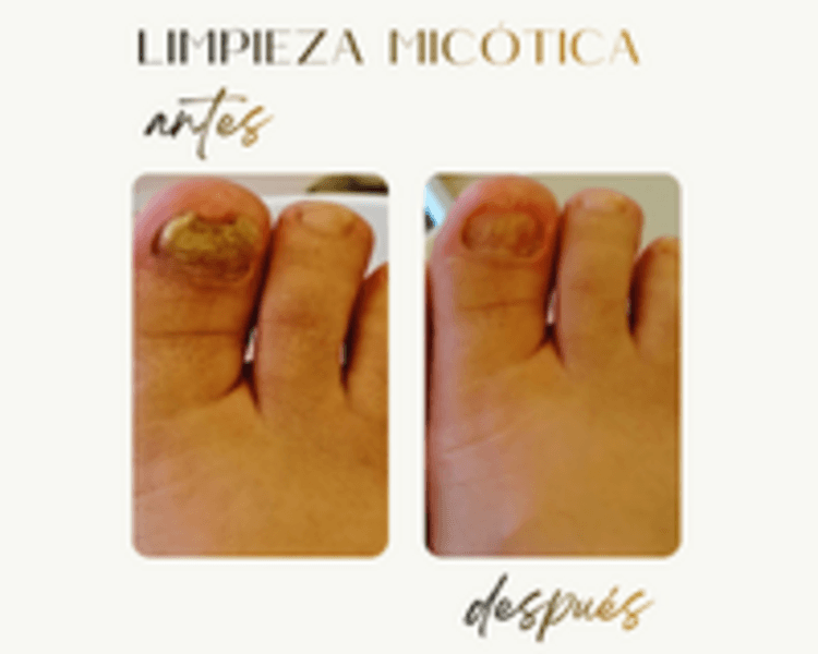 Limpieza Micótica