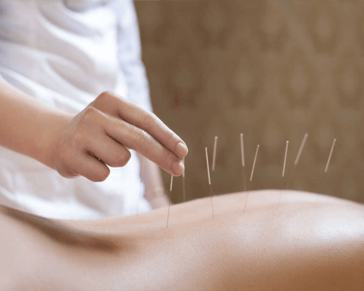 Acupuntura y Moxibustión