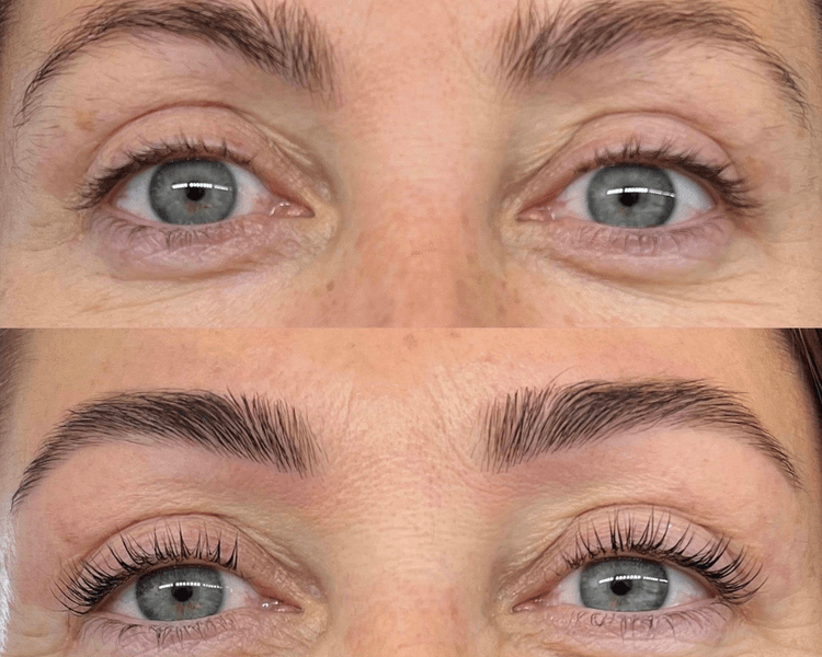 LIFTING- LAMINADO- PERFILADO