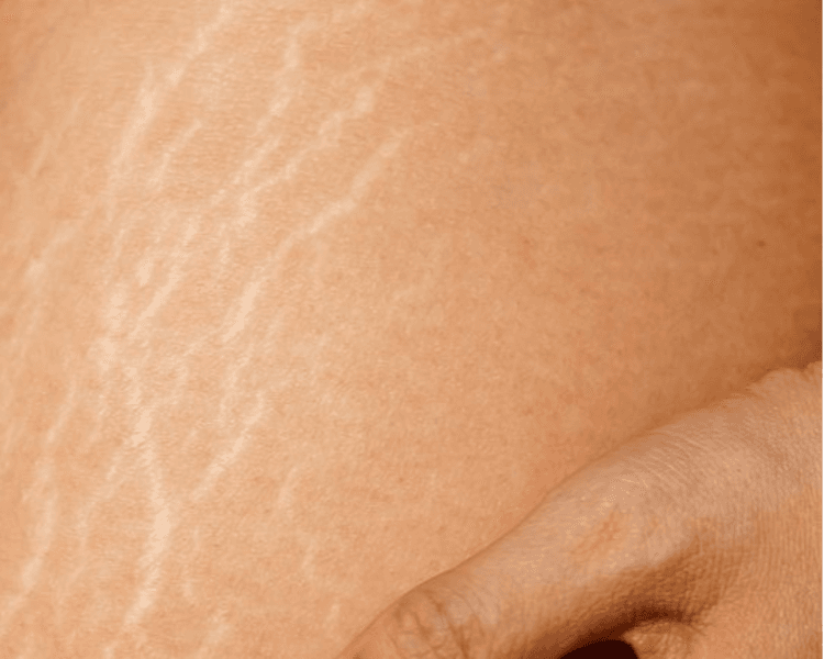 Tratamiento Estrías