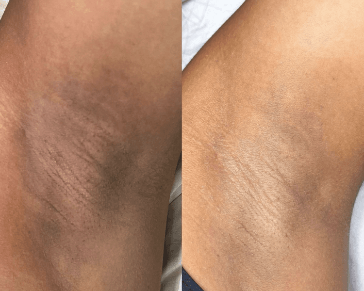 Despigmentación de zonas sensibles