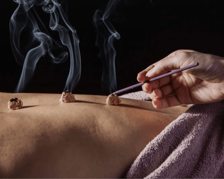 Moxibustión o moxas