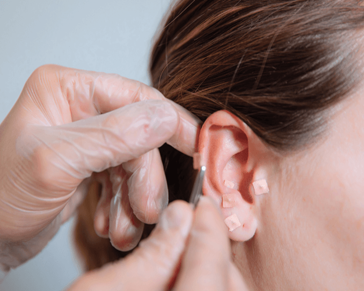 Promoción Sesion de Acupuntura + Ventosa + Auriculoterapia