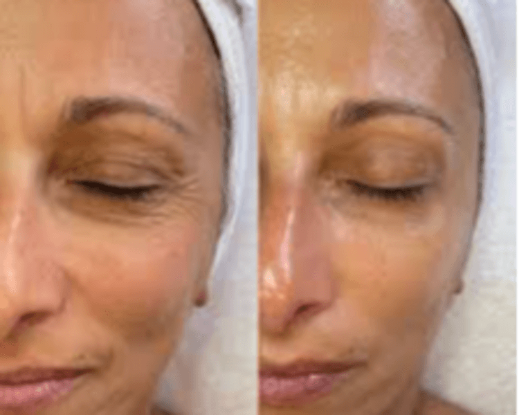 Tratamiento antiage Ultra Exosomas (premium)