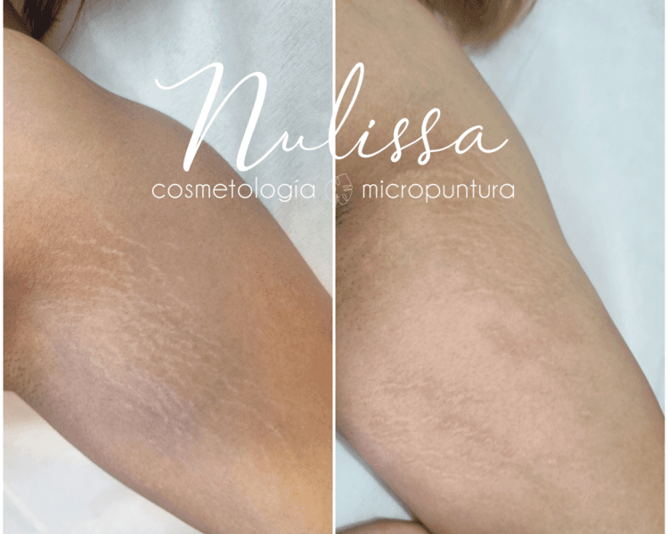 Sesión de Micropuntura