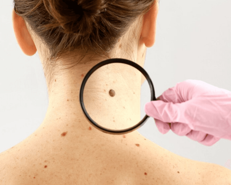 CONTROL DE LUNARES - OSDE/ Swiss Medical