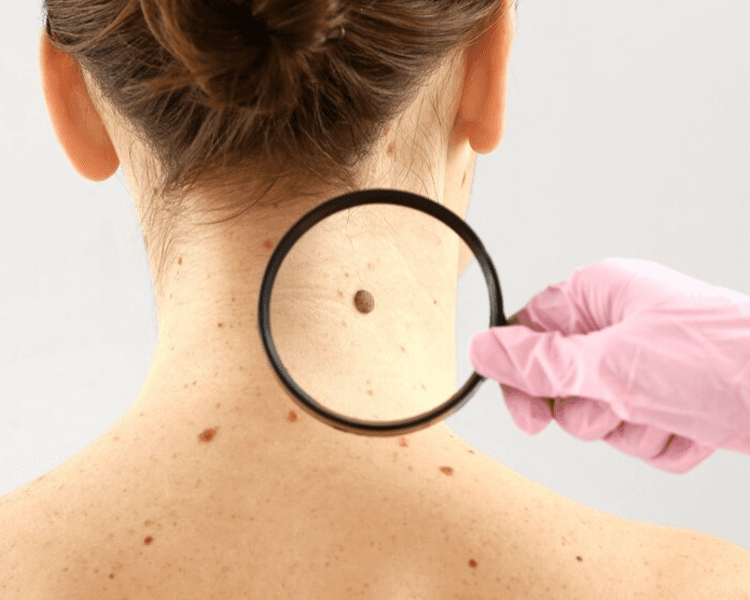 CONTROL DE LUNARES - PARTICULAR