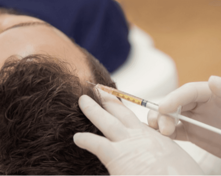 PLASMA RICO EN PLAQUETAS CAPILAR